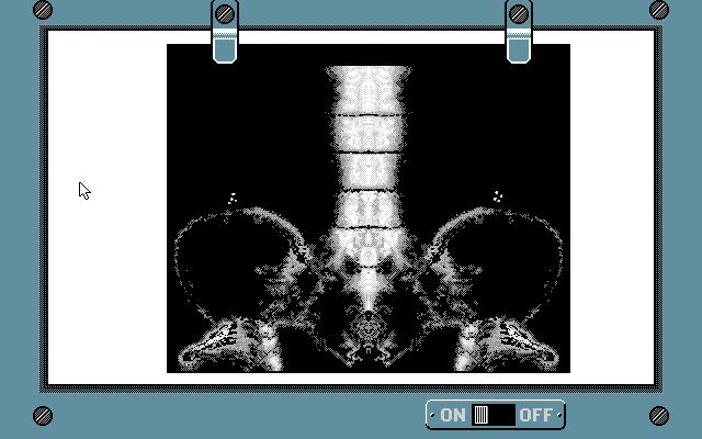 Life & Death (FM Towns) screenshot: The plot thickens, X-Ray reveals that the patient has bones in his body... fascinating